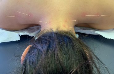 Dry Needling