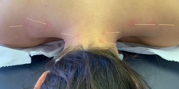 Dry Needling for Neck and Shoulder Pain