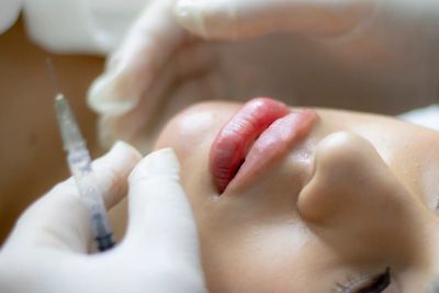 Close-up of lip injection procedure with gloved hands and syringe.