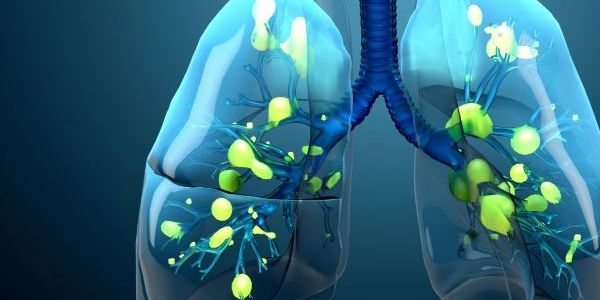 3D rendering of inflamed lymph nodes in lungs.