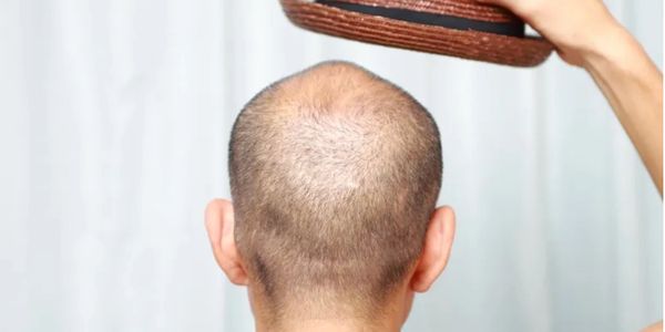 scalp micropigmentation services