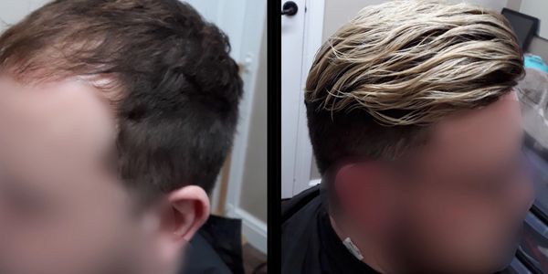 male hair loss before and after hair replacement darlington