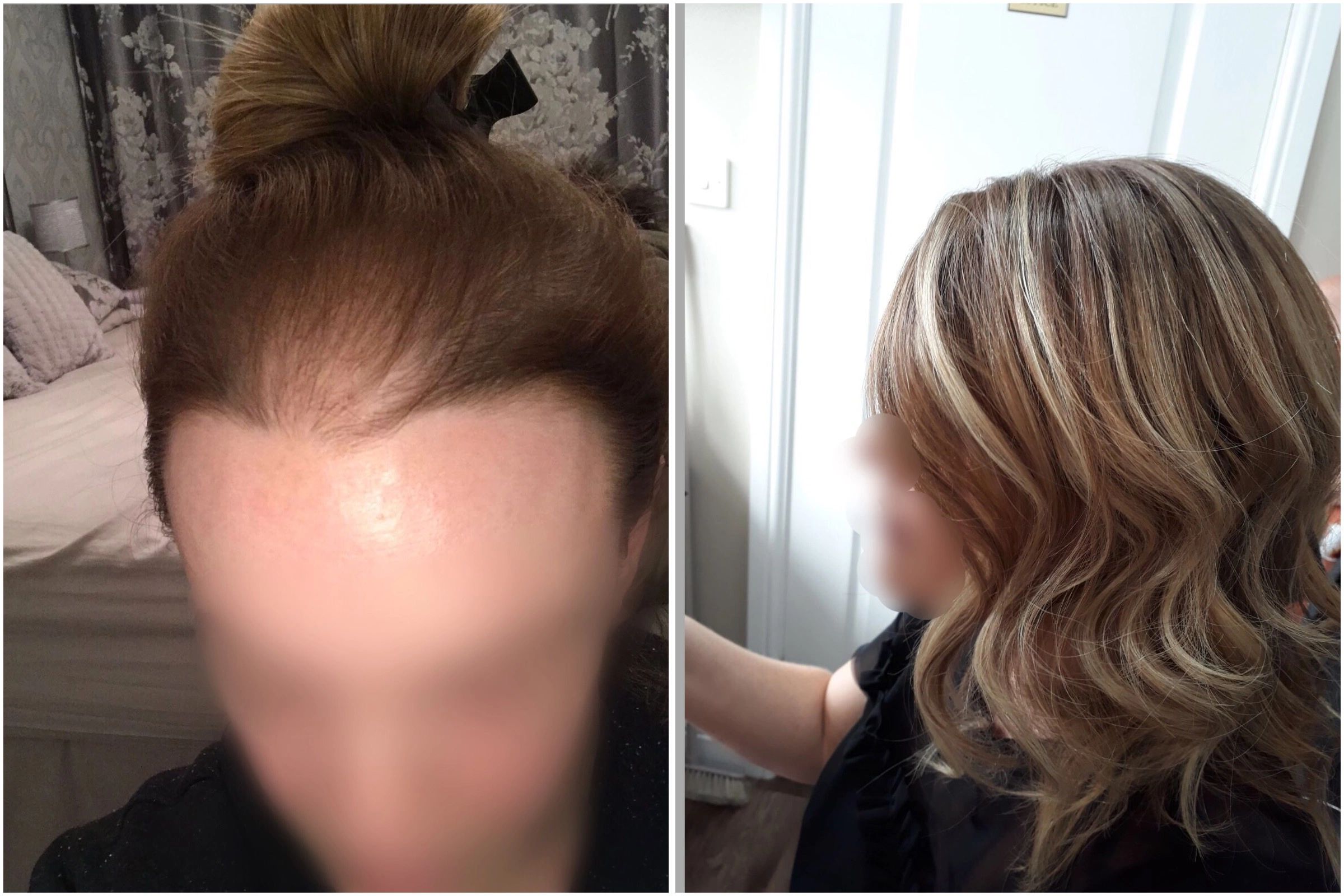 Female Hair Loss On The Crown And Around The Front Hairline