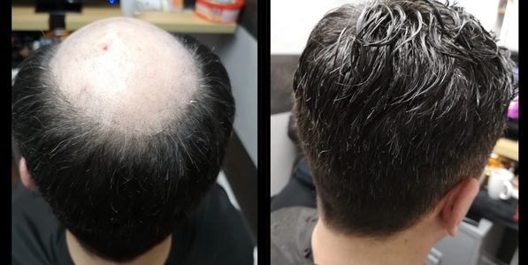 Male baldness hair replacement system 