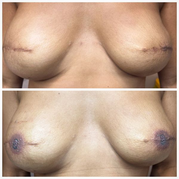 Areola tattooing by Laura Jane Powell 