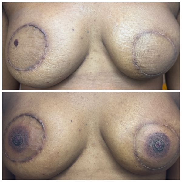 Areola tattooing 