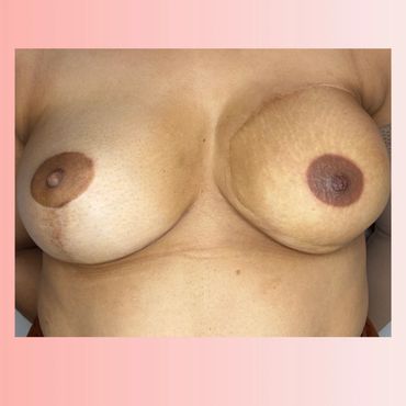 Areola tattoo on DIEP