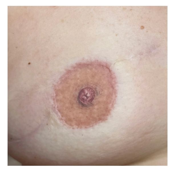 Areola tattooing by Laura Jane Powell 