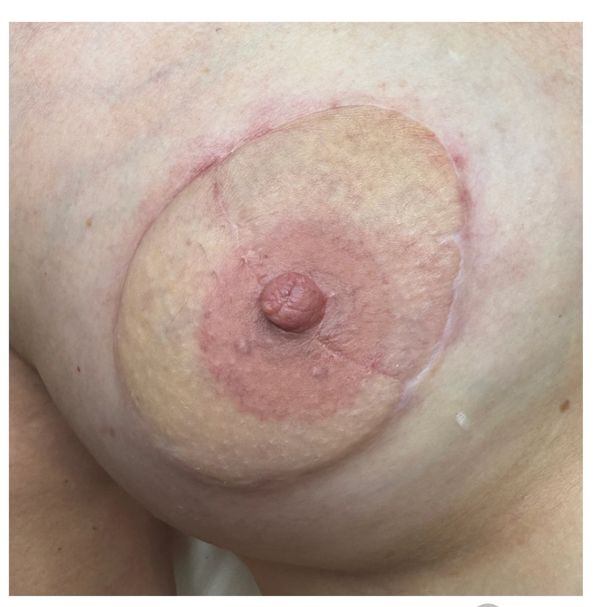 Areola tattooing by Laura Jane Powell 