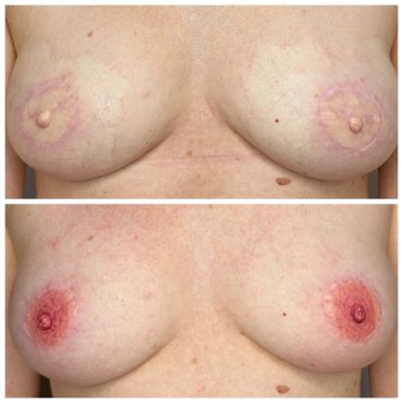 Before and after breast areola tattooing.