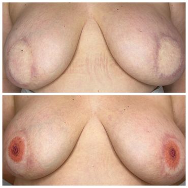 3D Areola tattoos on diep