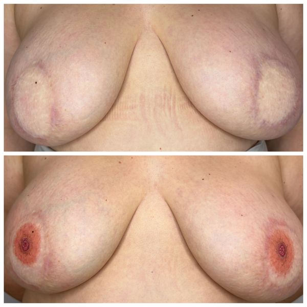 3D Areola tattoos on diep