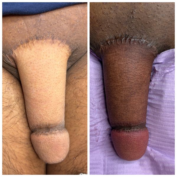 Phalloplasty tattooing 