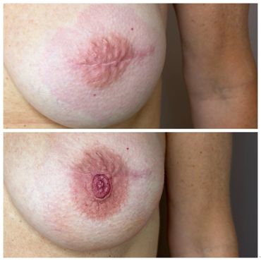 Areola tattoo over implant