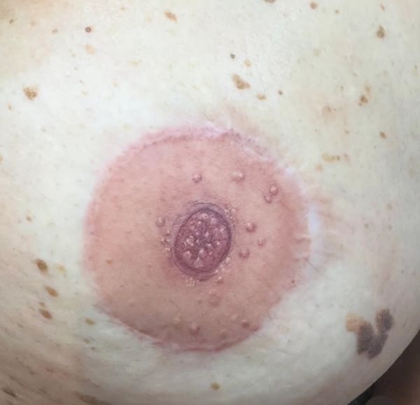 3d hyperrealism tattooing after cancer
