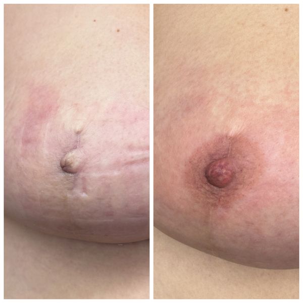 Tattoo over nipple reconstruction 