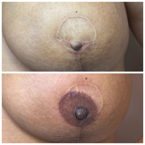 Areola tattooing by Laura Jane Powell 