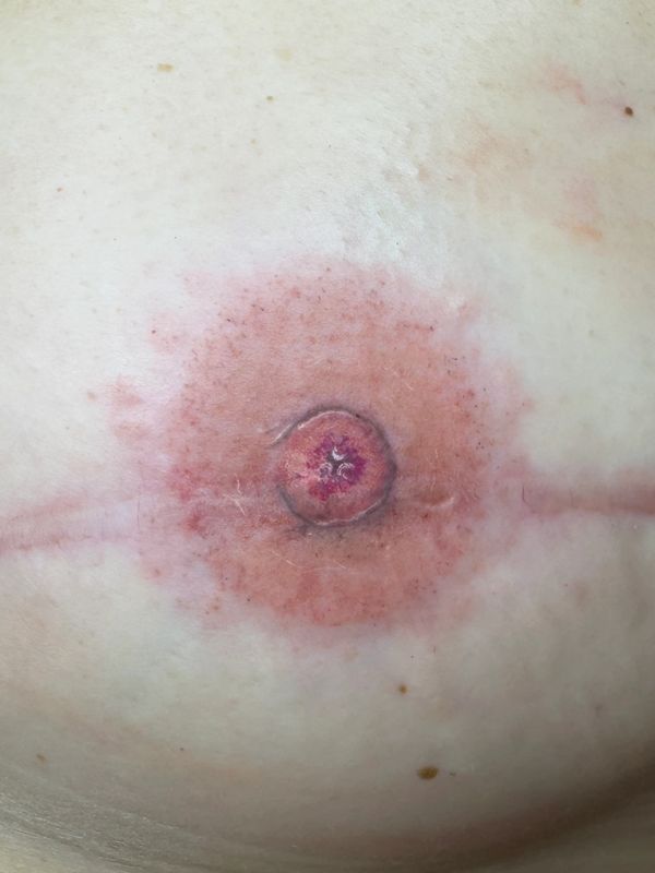 Areola tattooing by Laura Jane Powell 