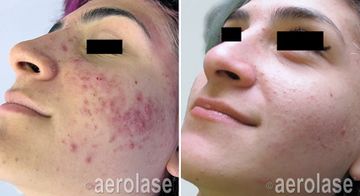 NEOCLEAR BY AEROLASE® ACNE TREATMENT