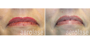 NEOSKIN BY AEROLASE® LIP REJUVENATION 