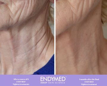 ENDYMED 3DEEP® Skin Tightening