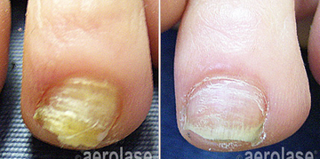 NEOSKIN BY AEROLASE® NAIL FUNGUS