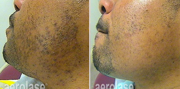 NEOCLEAR BY AEROLASE® PSEUDOFOLLICULITIS BARBAE