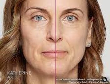 Before and after picture of sculptra