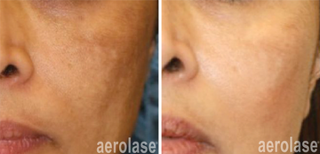 NEOSKIN BY AEROLASE® MELASMA AND HYPERPIGMENTATION