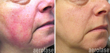 Rosacea and redness vascular treatments with Neo by Aerolase.