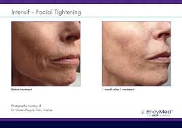 Endymed face lift