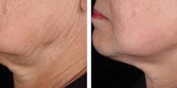 neck lifting 
