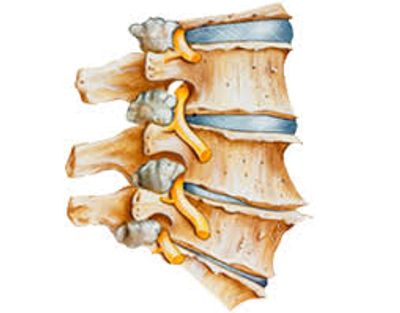 Degenerative Disc Disease | RMI Stem Cells