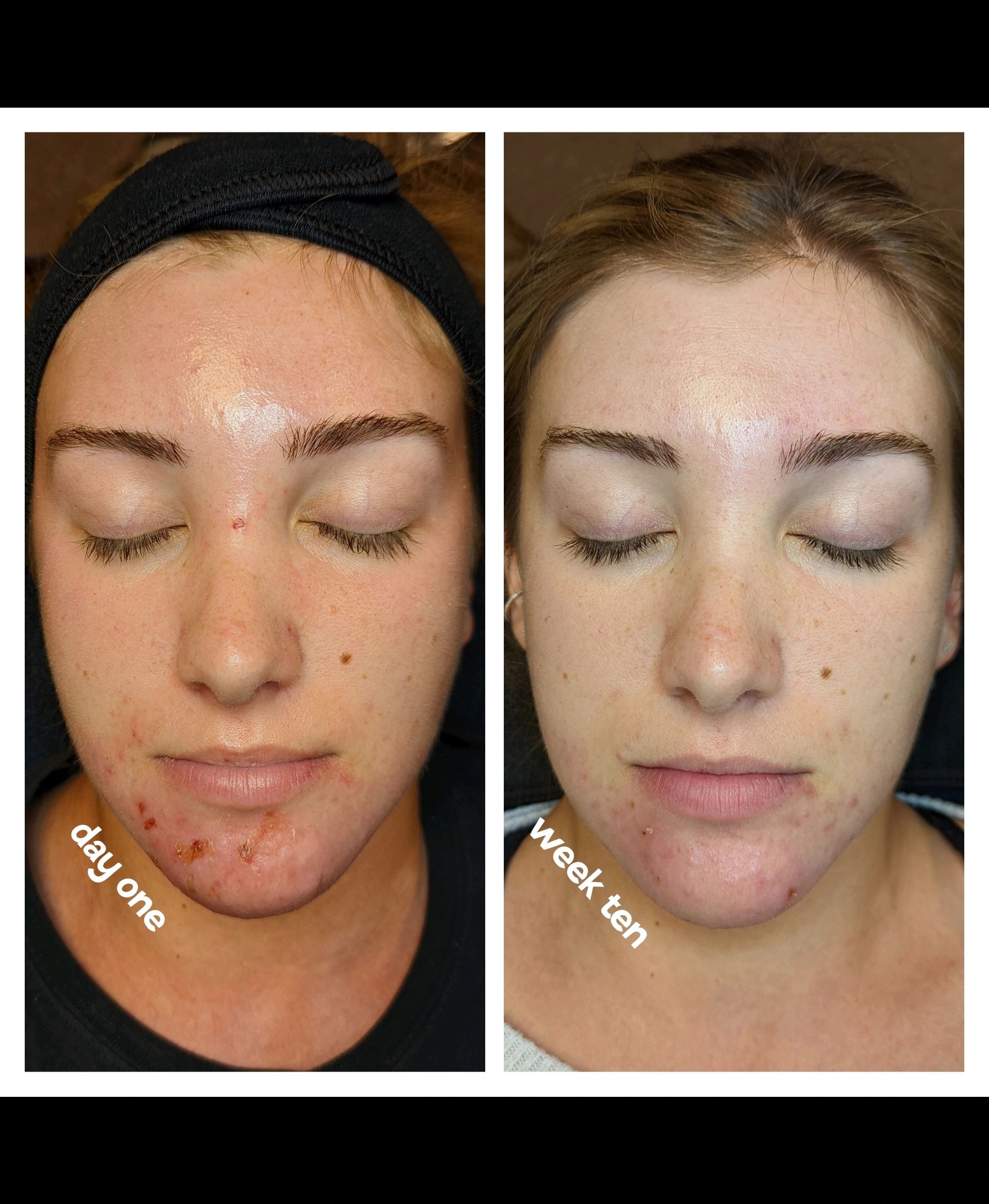 Origin Skin Studio Acne Treatment Appleton, Wisconsin