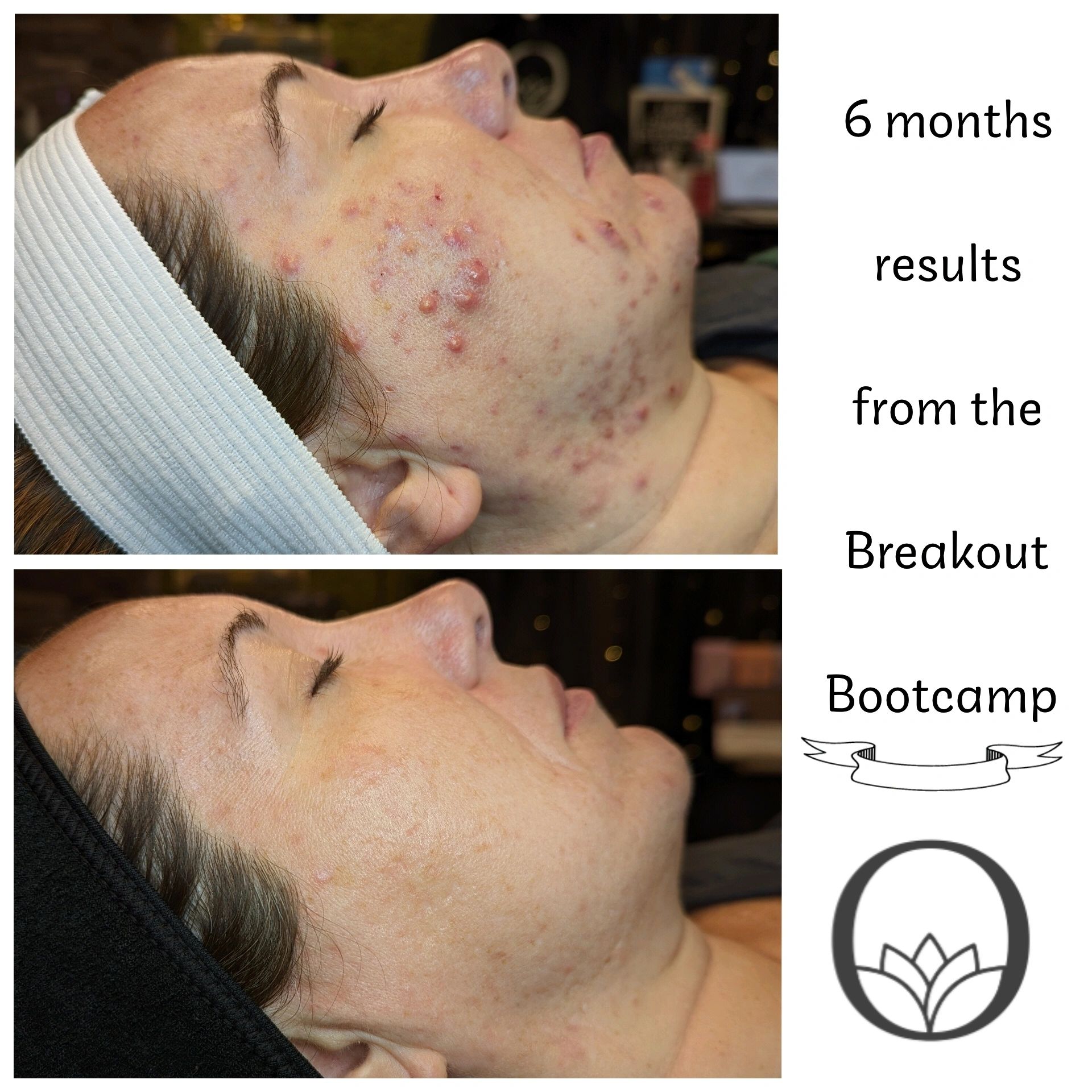 Origin Skin Studio Acne Treatment Appleton, Wisconsin