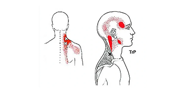 Trigger Point Therapy