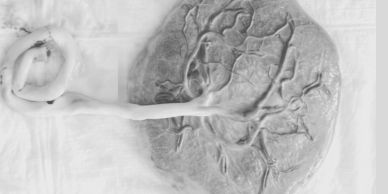 Black and white image of a placenta with umbilical cord.