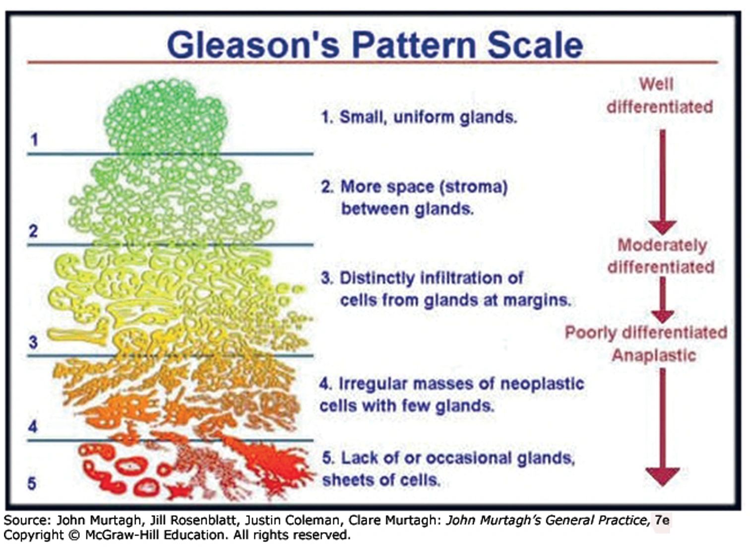 Глисон рак предстательной. Gleason score. Классификация по глисону. Шкала Глисона. Глиссон 3+3.