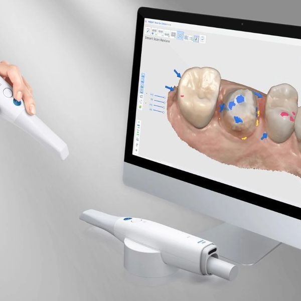 Escáner 3D Intraoral para realizar medidas digitales, con ellos imprimiremos en 3D tu boca