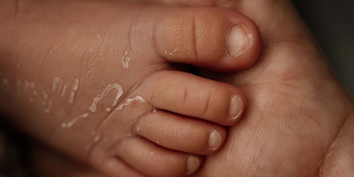Close-up of a newborn baby tiny toes with peeling skin.