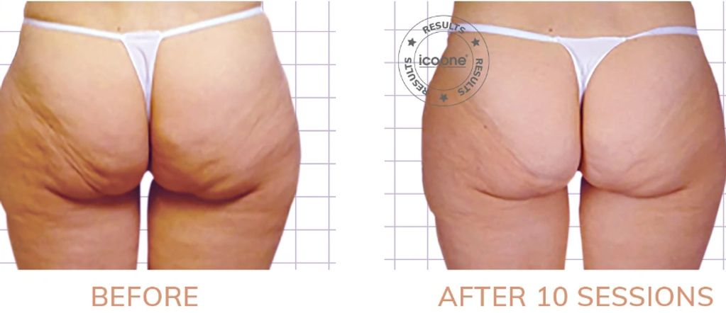 remove cellulite from back of legs. remove cellulite from butt.