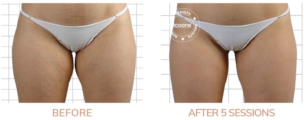 remove fat from thighs in Troy, MI