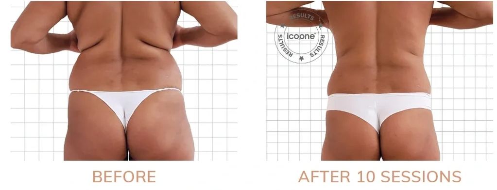 remove back fat. lose back fat in Troy