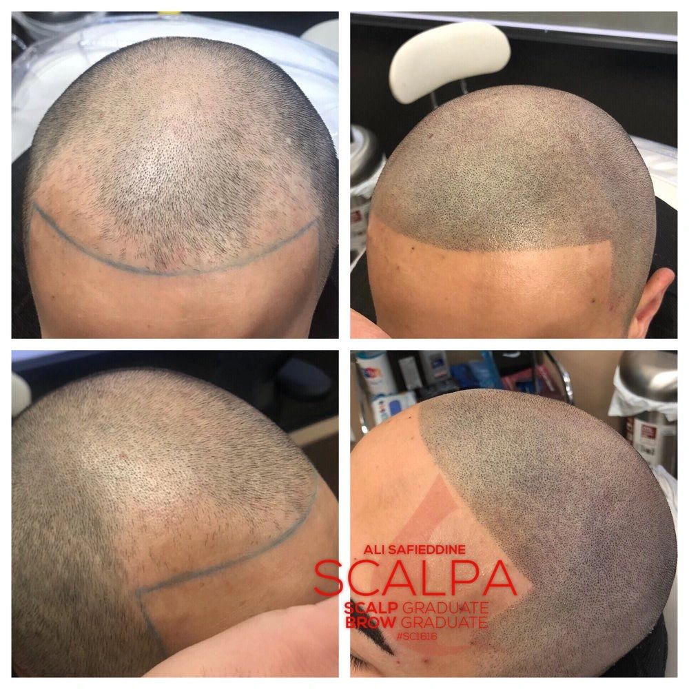 Considering a 'Hair Tattoo?' hair transplant, hair loss treatment Considering a 'Hair Tattoo?' hair transplant, hair loss treatment