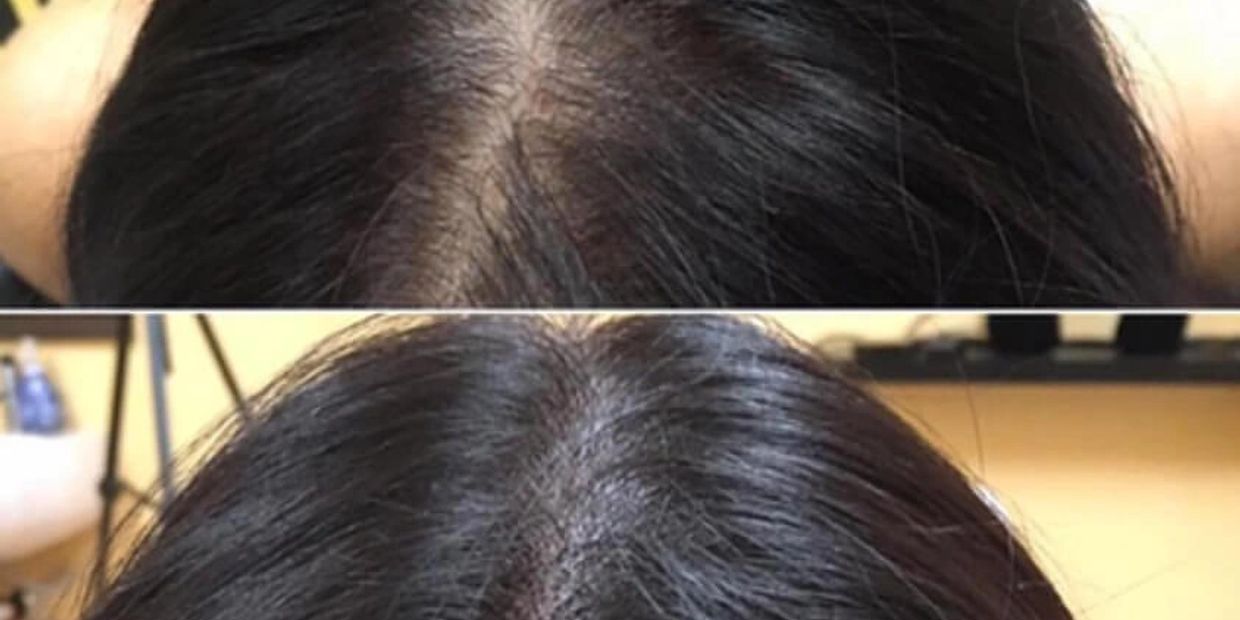 women hair loss, thinning hair treatment 
