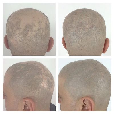 Alopecia Treatment 