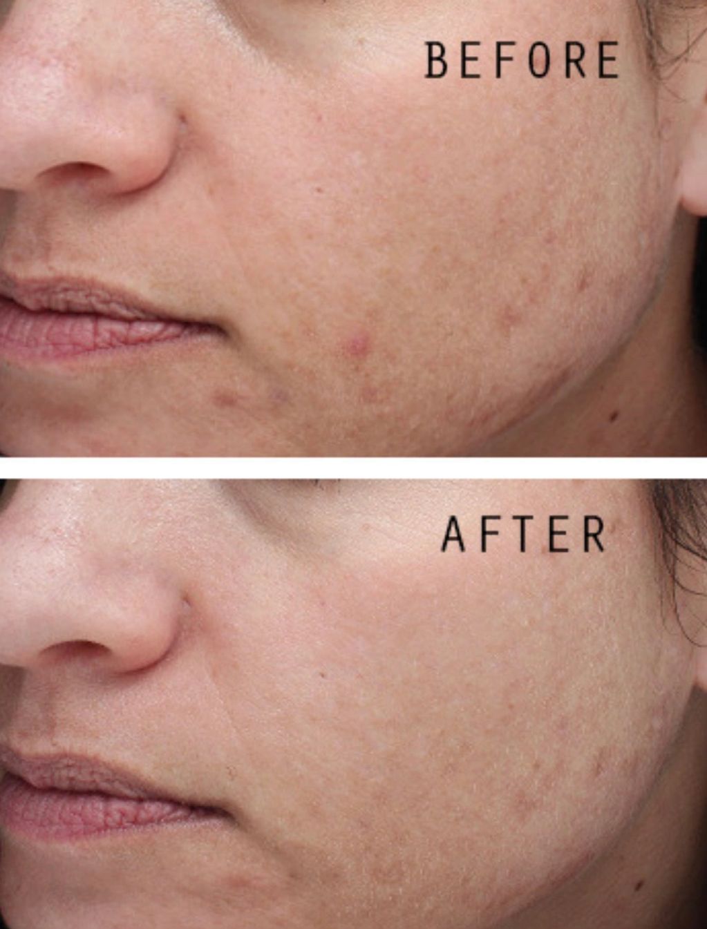 Pro Power Peel before and after course of 3