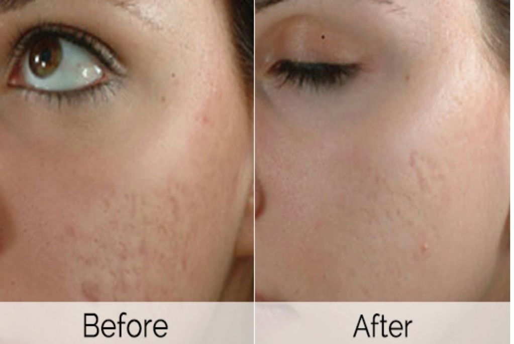 Pro Power Peel before and after course of 3