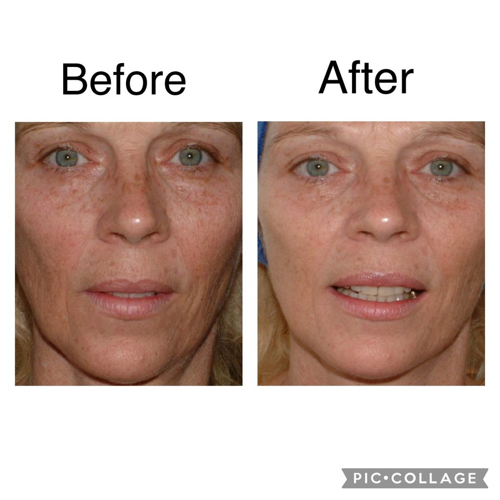 Results from 3 microneedling skin therapy sessions 