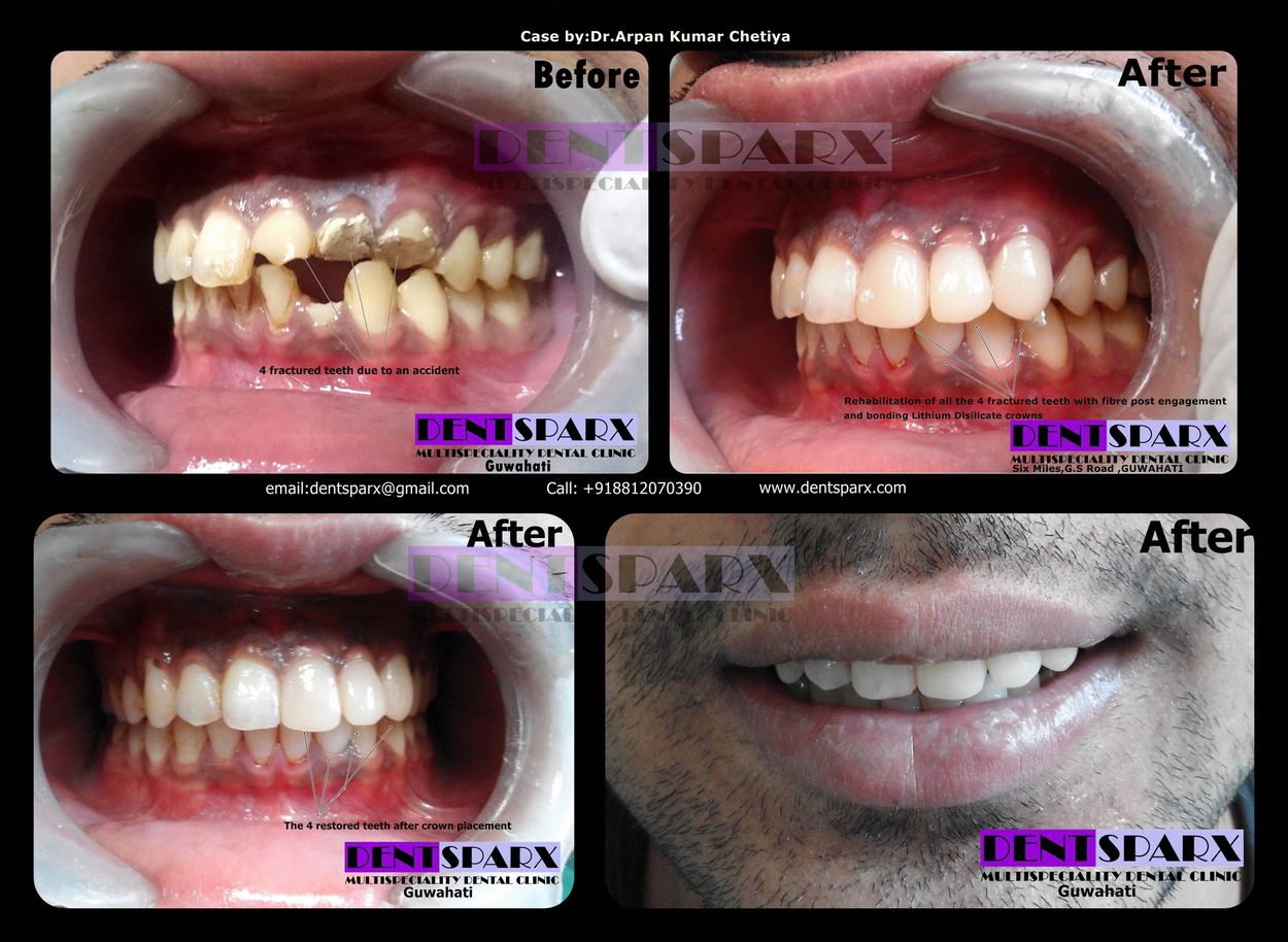 Fractured teeth rehab with post and core followed by crown palcement done at Dentsparx dental clinic